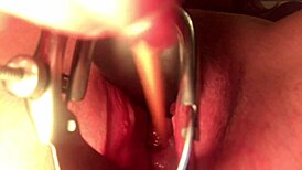 The deep penetration of cervix