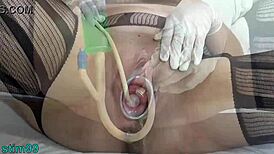 Extreme Cervix Prolapse Demonstration